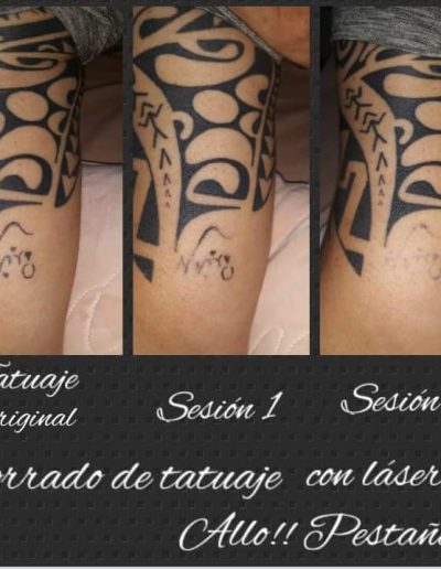 laser-eliminación de tatuajes- eliminación de vello- depilación